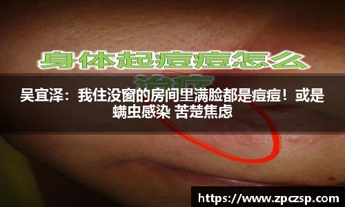 吴宜泽：我住没窗的房间里满脸都是痘痘！或是螨虫感染 苦楚焦虑